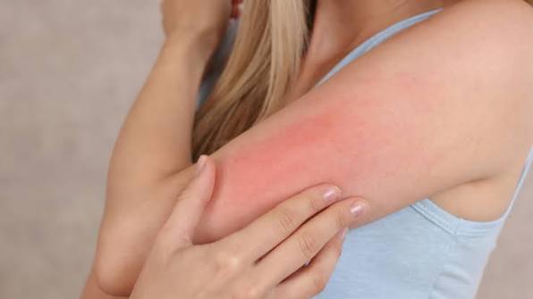 Allergy treatment