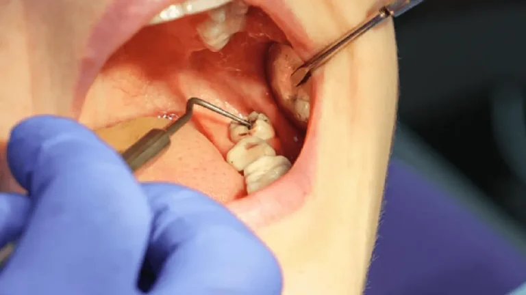 Wisdom Teeth removal
