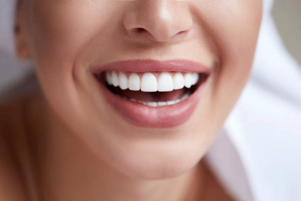 teeth whitening Applecross