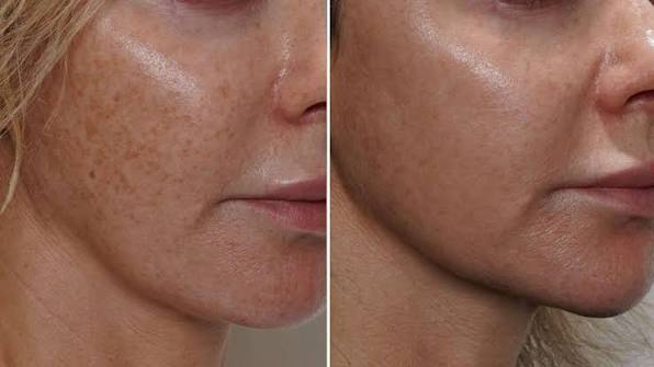 pigmentation removal melbourne