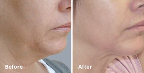 Double Chin Treatment Melbourne